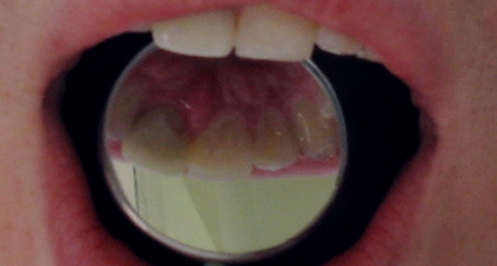 My Chipped Tooth